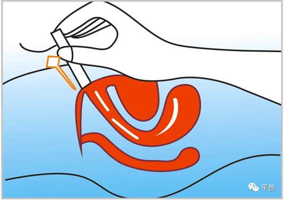 陰道填塞使用圖3