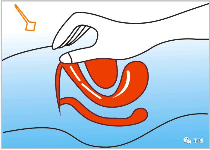 陰道填塞使用圖2